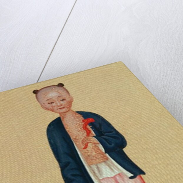 Child with smallpox by School Chinese