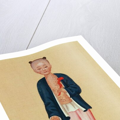 Child with smallpox by School Chinese