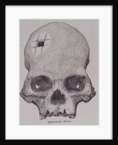 Trepanned Skull by English School
