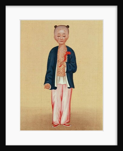 Child with smallpox by School Chinese