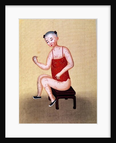 Child with smallpox by School Chinese