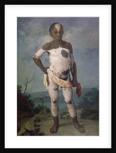 Child with Vitiligo, 1786 by Brazilian School