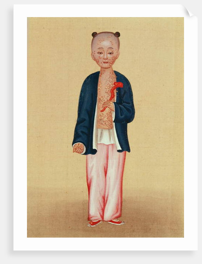 Child with smallpox by School Chinese