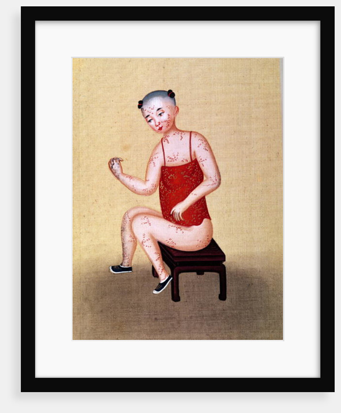 Child with smallpox by School Chinese