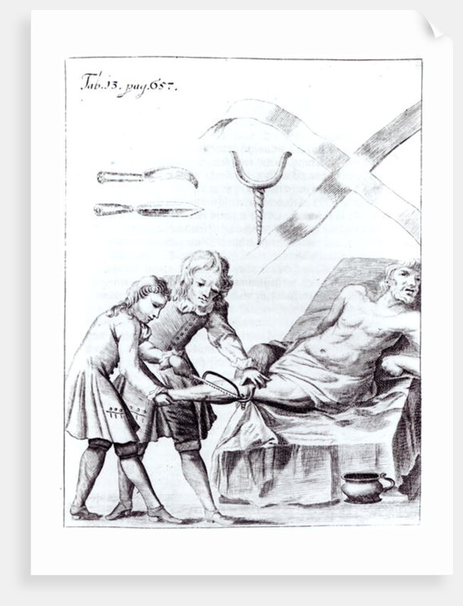 Surgical operation to amputate a leg by English School