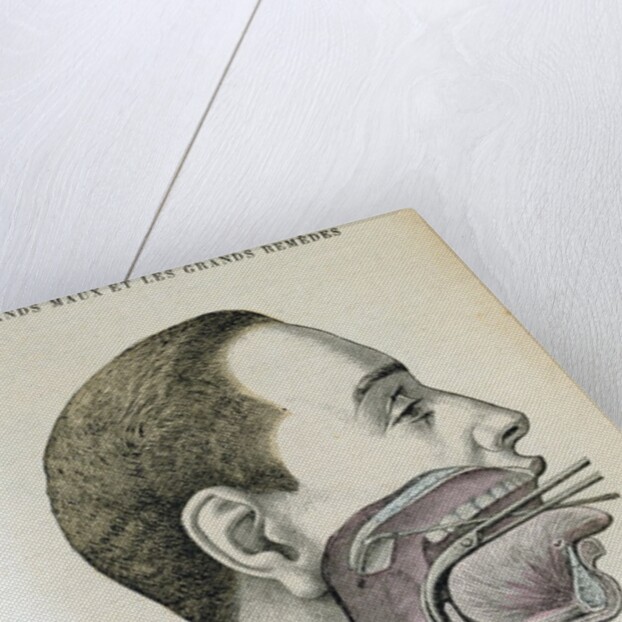 Polyp removal by Anonymous