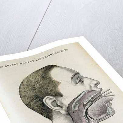 Polyp removal by Anonymous
