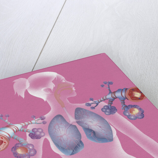 Asthma, drawing by Anonymous