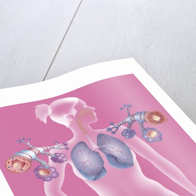 Asthma, drawing by Anonymous