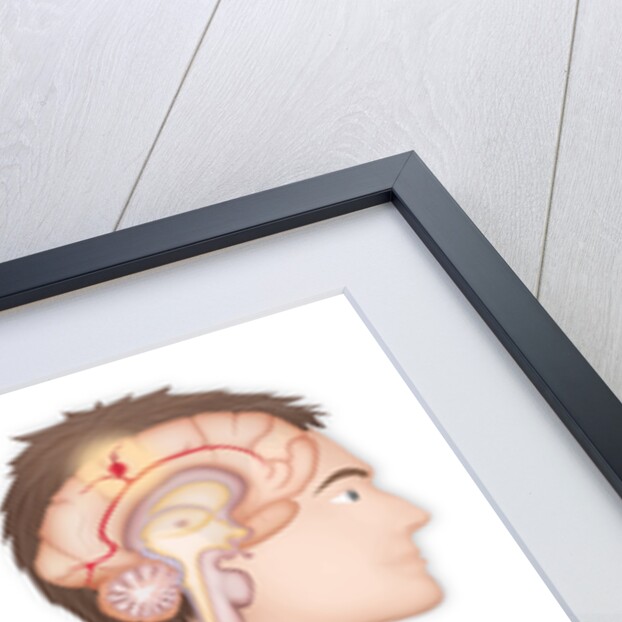 Cerebrovascular neurol. disease by Anonymous