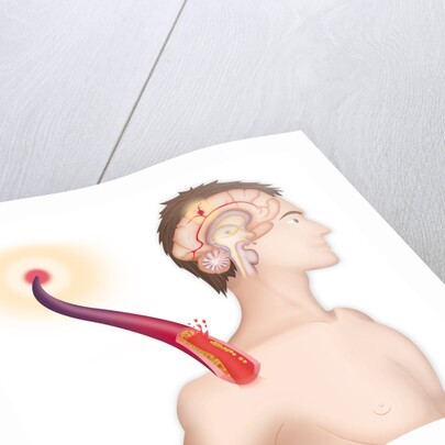 Cerebrovascular neurol. disease by Anonymous