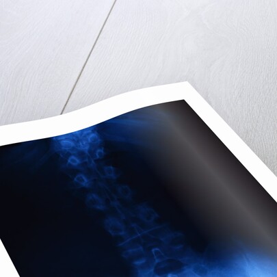X-Ray of Human Lower Spine by Anonymous