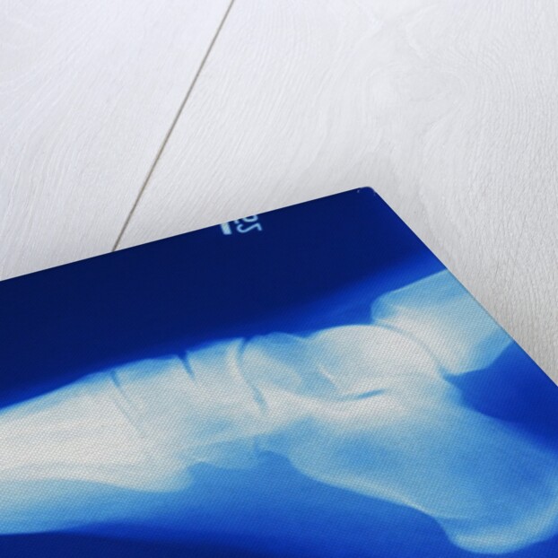 X-Ray of Person's Foot by Anonymous