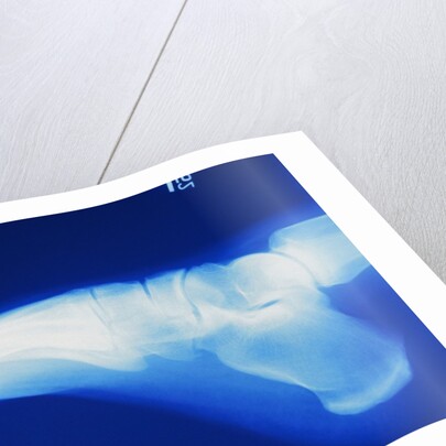 X-Ray of Person's Foot by Anonymous