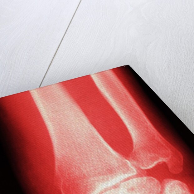 X-ray of a Wrist by Anonymous