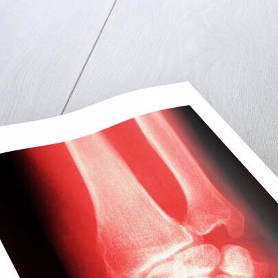 X-ray of a Wrist by Anonymous