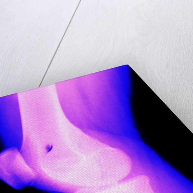 X-Ray of a Knee by Anonymous
