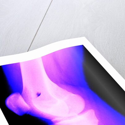 X-Ray of a Knee by Anonymous