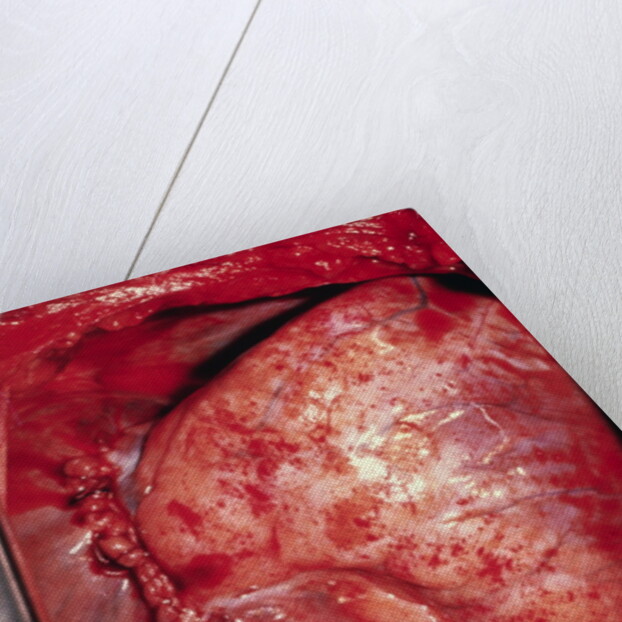 Donor's Heart in Thomas' Chest by Anonymous