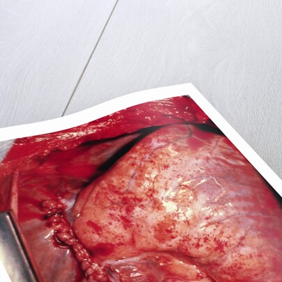 Donor's Heart in Thomas' Chest by Anonymous