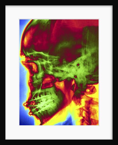 X-ray of Skull With Jaw Wiring by Anonymous