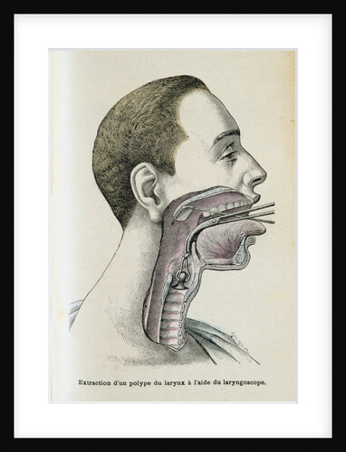 Polyp removal by Anonymous