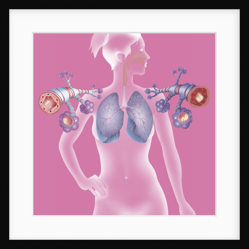 Asthma, drawing by Anonymous