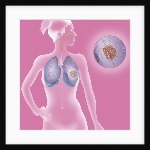 Lung cancer, drawing by Anonymous
