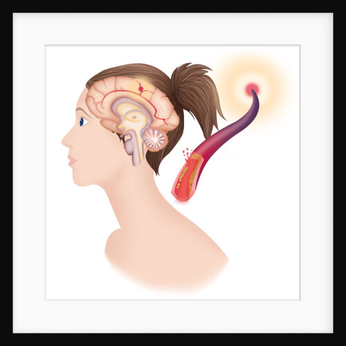 Cerebrovascular neurol. disease by Anonymous