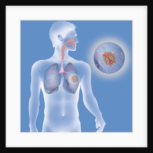 Lung cancer, drawing by Anonymous