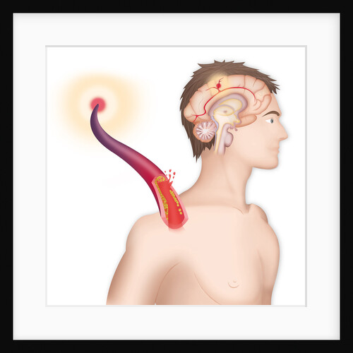 Cerebrovascular neurol. disease by Anonymous