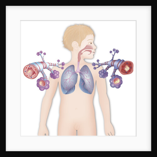 Asthma, drawing by Anonymous