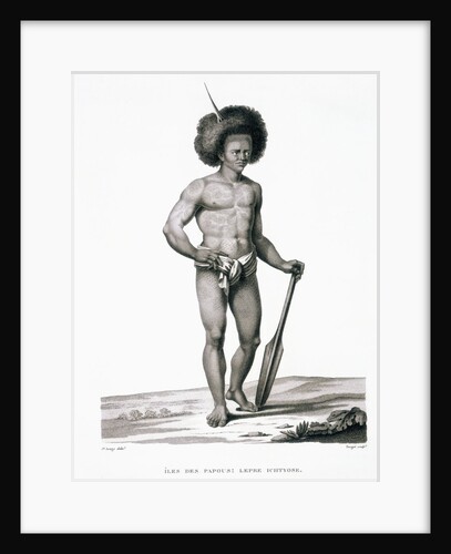 Papua Islands: Ichthyosis Leprosy Book Illustration by Anonymous