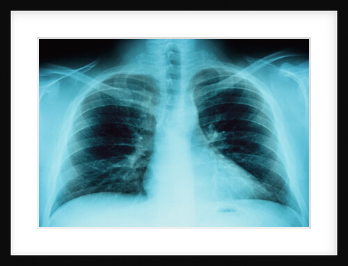 X-Ray of Dark Lungs by Anonymous
