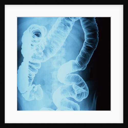 X-Ray of Intestines by Anonymous