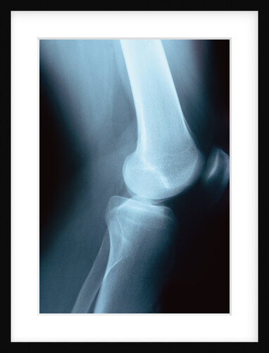 Knee Joint X-Ray by Anonymous