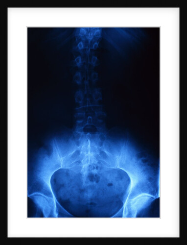 X-Ray of Human Lower Spine by Anonymous