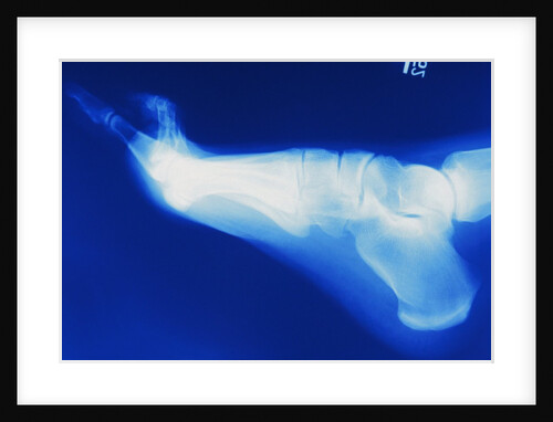 X-Ray of Person's Foot by Anonymous