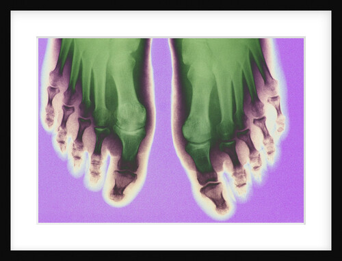 X-ray of Feet by Anonymous