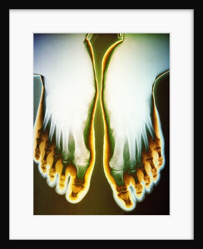 X-ray of Feet by Anonymous