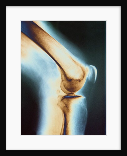 Knee X-ray by Anonymous