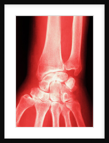 X-ray of a Wrist by Anonymous