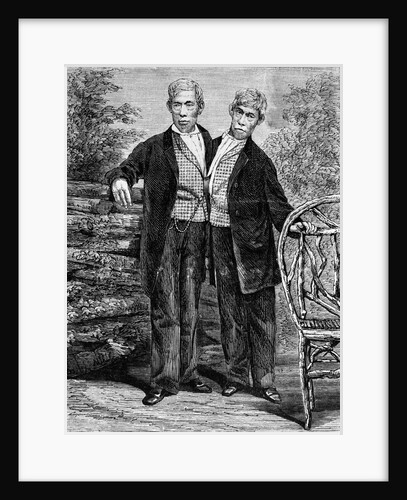 Siamese Twins Attached at Chest by Anonymous