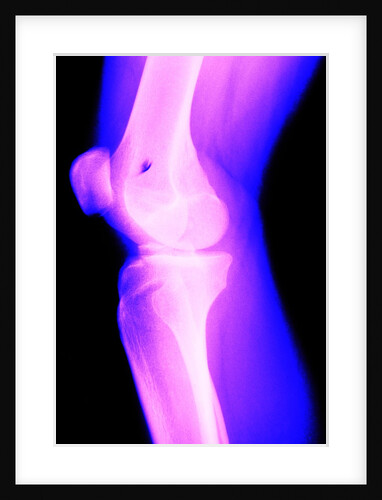 X-Ray of a Knee by Anonymous