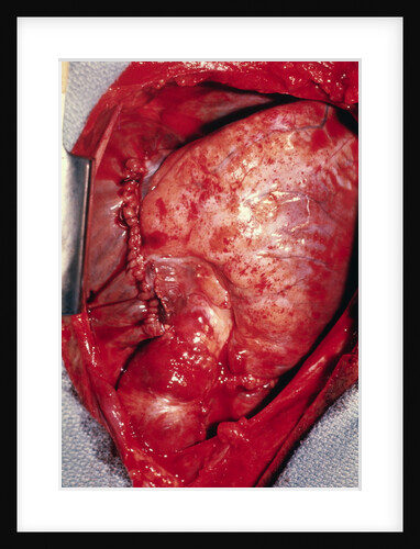 Donor's Heart in Thomas' Chest by Anonymous
