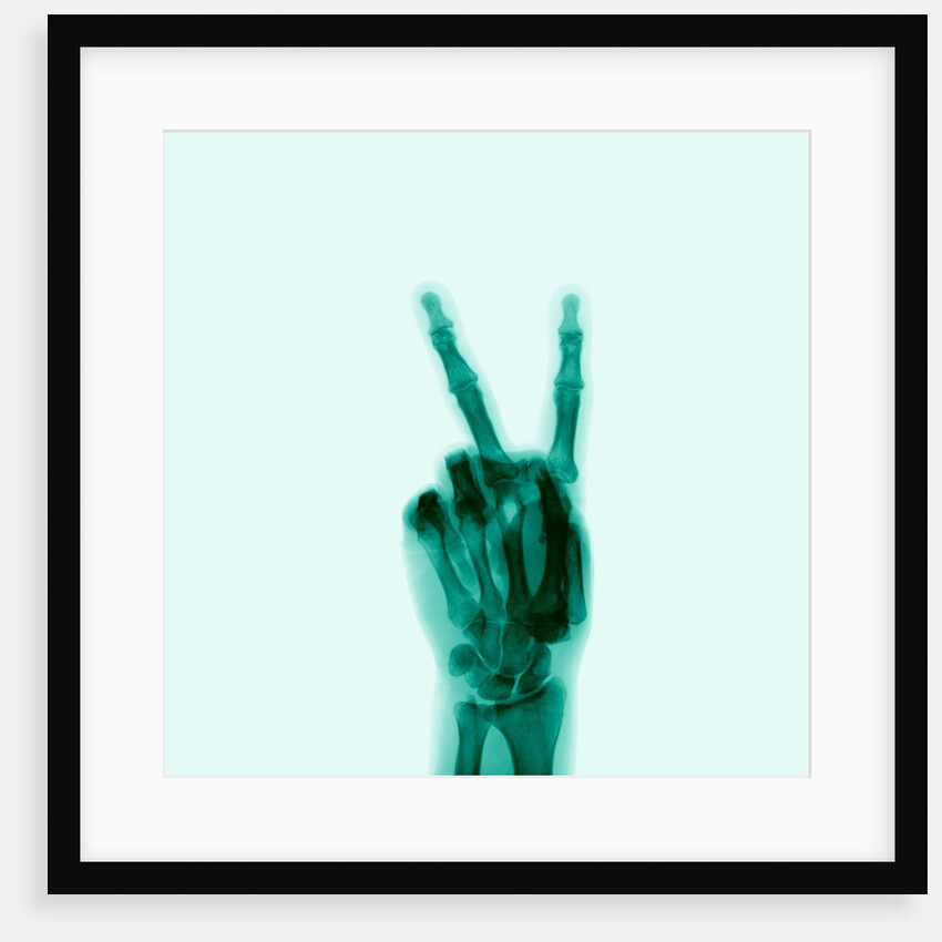 X-Ray of Hand Doing Peace Sign by Anonymous