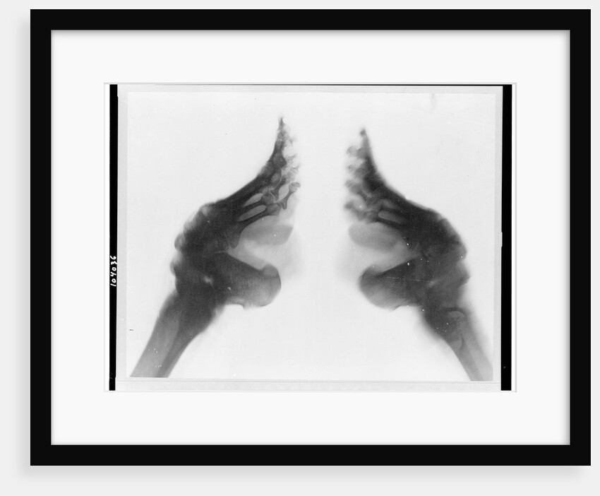 X-Ray of Bound Feet by Anonymous