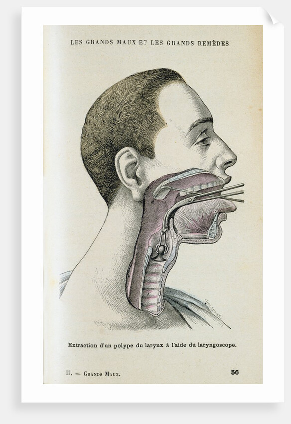 Polyp removal by Anonymous