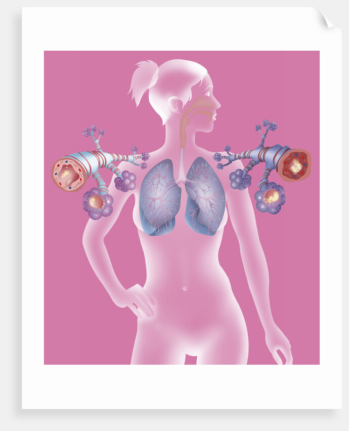 Asthma, drawing by Anonymous