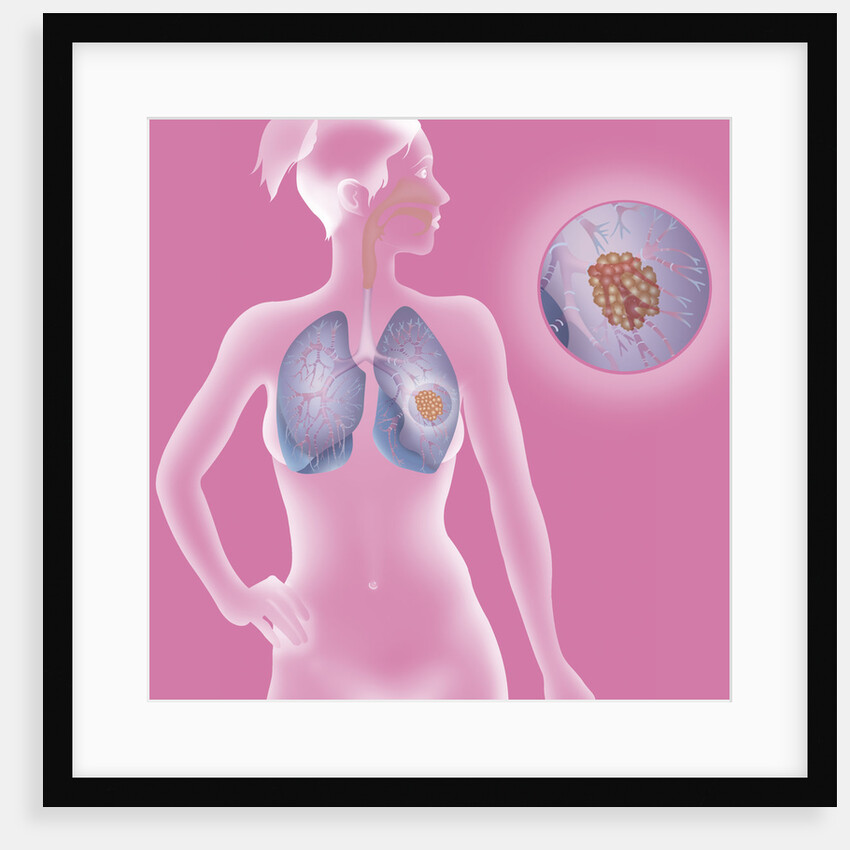 Lung cancer, drawing by Anonymous